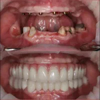 خدمات دندانپزشکی با اقساط ۱۵ ماهه + وام