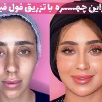 تخفیفات جمعه سیاه با بوتاکس رایگان توسط پزشک