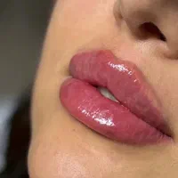آموزش تزریق فیلر،بوتاکس و لیزر توسط پزشک