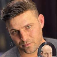 پروتز و ترمیم مو تخصصی میلادویسی