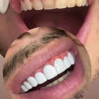 جشنواره کامپوزیت دندان|خدمات آرایشگری و زیبایی|شاهرود, |دیوار