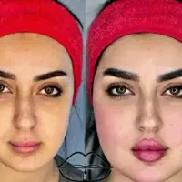 مرکز تخصصی فیلر فول فیس وبادی کانتورینگ صورت وبدن