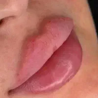 تزریق ژل و بوتاکس،پرسینگ،حجامت،خالبرداری،مزوتراپی