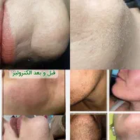 حذف دائمی موهای سفید،بور و مشکی صورت  با الکترولیز