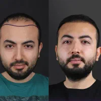 آف تابستانه کاشت مو و ابرو