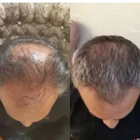 فقد ۱۵ روز برای خلاص شدن از شر ریزش مو