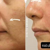 بوتاکس جوانساز آنزیم فیلر|خدمات آرایشگری و زیبایی|ملایر, |دیوار