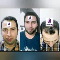 تخفیف پاییز تا یلدا کاشت مو و ابرو و مژه|خدمات آرایشگری و زیبایی|زاهدان, |دیوار