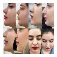تزریق انواع ژل و بوتاکس|خدمات آرایشگری و زیبایی|شیراز, شهرک والفجر|دیوار