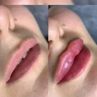 لیزر موهای زاید فیلر ژل بوتاکس مزو خال هایفو prp