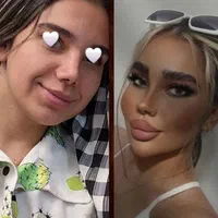 تزریق (ژل،بوتاکس،نخ)قیمت مناسب|خدمات آرایشگری و زیبایی|ملارد, |دیوار