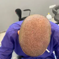 آموزش کاشت مو