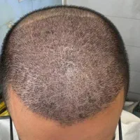 کاشت مودر یک روز باتیم حرفه ای و با سابقه در همدان