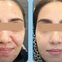 بیومیمتیک(اورجینال)