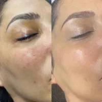 کربن تراپی (پیلینگ هالیودی)در مطب پزشک