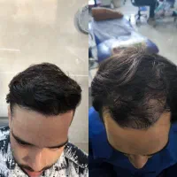 کاشت مو با خط رویش طبیعی و ضمانت نامه|خدمات آرایشگری و زیبایی|یاسوج, |دیوار