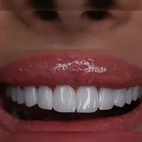 دندانپزشکی / کامپوزیت دندان / لمینت و ایمپلت