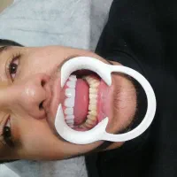 کامپوزیت دندان هر فک 5تومن|خدمات آرایشگری و زیبایی|محمدشهر, محمدشهر|دیوار