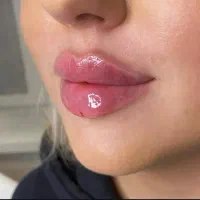 تزریق تخصصی فیلر و مزو