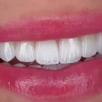 کامپوزیت دندان روکش دندانپزشک تهرانسر اکباتان پونک|خدمات آرایشگری و زیبایی|تهران, تهرانسر شمالی|دیوار