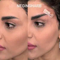 تزریق چربی فیلر کانتورینگ بوتاکس نخ لیفت مزوتراپی|خدمات آرایشگری و زیبایی|اصفهان, بوستان آینه خانه|دیوار