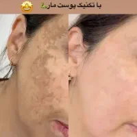 جشنواره درمان تضمینی کک و مک/ زگیل / فقط در 1 جلسه