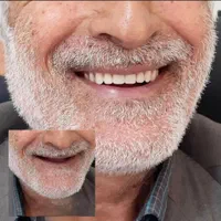 دندانسازی،دست دندان،دندان مصنوعی،پارسیل،پروتزمتحرک|خدمات آرایشگری و زیبایی|کرج, کوی مدرس|دیوار