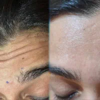 فیلر ، بوتاکس ، ژل ، مزو ابرو و مو