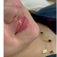 فیلر ژل لب کاملا طبیعی و اقتصادی بوشهر تضمین کیفیت