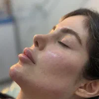 تزریق فیلر یک سی سی 890(تخفیف ویژه تا پایان هفته)