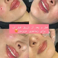 مطب زیبایی لیزر بوتاکس ژل مزو نخ لک جوش|خدمات آرایشگری و زیبایی|لردگان, |دیوار