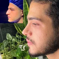 عمل زیبایی بینی و پلک