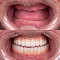 دندان مصنوعی قالب گیری در منزل|خدمات آرایشگری و زیبایی|کرج, کوی امامیه|دیوار