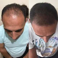 مشاوره ریزش مو و رویش مجدد|خدمات آرایشگری و زیبایی|مشهد, کلاهدوز|دیوار