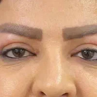 بلفاروپلاستی (پف چشم )، سانترال لب در رشدیه|خدمات آرایشگری و زیبایی|تبریز, |دیوار