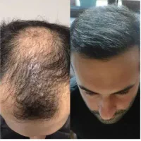 درمان با روش آلمانی
