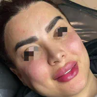 ژل/بوتاکس/و آف چربی/مزوژل/وآموزش