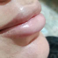 تزریق فیلر بوتاکس مزو