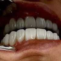 جشنواره کامپوزیت لمینیت روکش عصب ترمیم IMAX IPS|خدمات آرایشگری و زیبایی|تهران, هفت حوض|دیوار