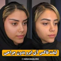 آف پکیج تخصصی FOX EYE پزشک پوست مو بینی زیبایی|خدمات آرایشگری و زیبایی|مشهد, هنرستان|دیوار