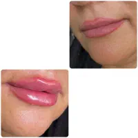 فیلر و بوتاکس