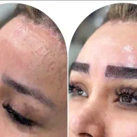 کاشت ابرو دائم در کلینیک پوست و مو