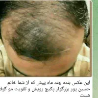 رویش مجدد مو