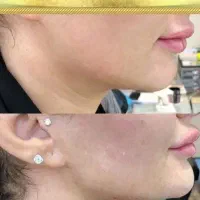 جشنواره تزریق ژل،فیلر،بوتاکس باقیمت کم هفده شهریور|خدمات آرایشگری و زیبایی|تبریز, |دیوار