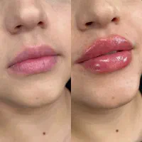 تخفیف ویژه روی کلیه کارهای زیبایی فیلر و بوتاکس|خدمات آرایشگری و زیبایی|شیراز, تاچارا|دیوار