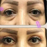 بلفاروپلاستی ( شوش ، شوشتر ، اندیمشک)