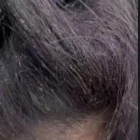 درمان شپش در عرض یه روز