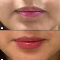 مدل تزریق فیلر و بوتاکس