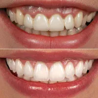 دندانپزشکی ونیر کامپوزیت و لمینت با شرایط پرداخت|خدمات آرایشگری و زیبایی|اصفهان, احمدآباد|دیوار