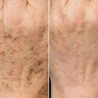 برداشتن خال.زگیل تناسلی.جای زخم و بخیه. میخچه|خدمات آرایشگری و زیبایی|کرمانشاه, |دیوار